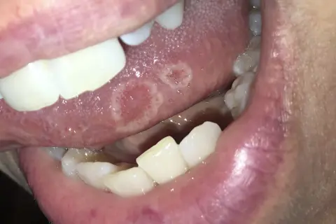 Lingua con afte. Quando preoccuparsi per queste lesioni dolorose?