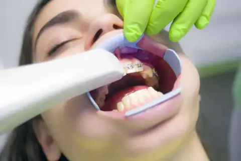 Dentysta zakłada aparat ortodontyczny. Dowiedz się, ile trwa zakładanie aparatu i jak przebiega wizyta.