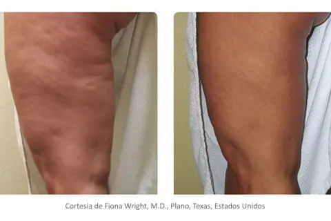 Comparación de radiofrecuencia corporal antes y después: pierna con celulitis visible antes, y pierna con piel más lisa y firme después.