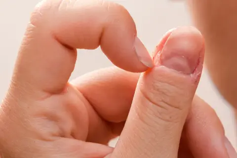 Dłoń z widocznym nawykiem obgryzania paznokci, skórki wokół paznokcia są zaczerwienione i podrażnione.
