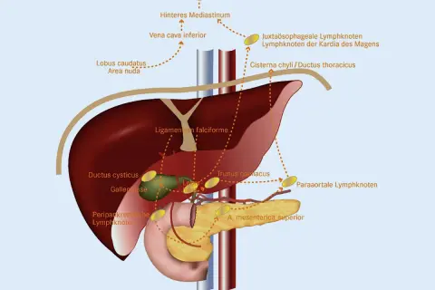 Anatomische Darstellung des Lymphknotenbesatzes im Bereich von Leber, Gallenblase und Bauchspeicheldrüse. Dargestellt sind verschiedene Lymphknotengruppen.