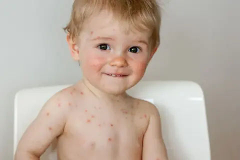 Czy dziecko ze strupami po ospie może iść do przedszkola? Fakty