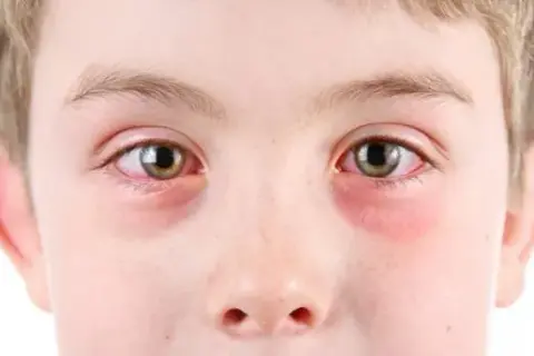 Alergia oczu: objawy, rozpoznanie i skuteczne sposoby na ulgę