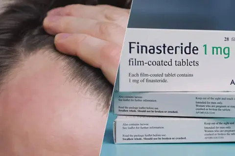 Mężczyzna dotyka przerzedzonych włosów obok pudełka leku Finasteride 1 mg, który może pomóc w walce z łysieniem.
