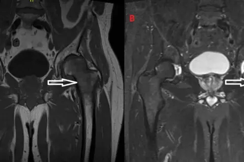 Risonanza magnetica pelvica: edema osseo nel femore sinistro, che potrebbe indicare un tumore.
