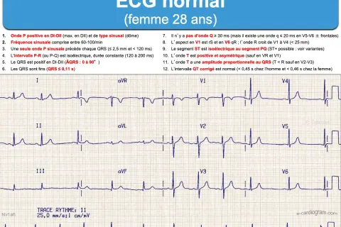 Électrocardiogramme (ECG) d'une femme de 28 ans, montrant un cycle cardiaque normal avec des ondes P, QRS et T caractéristiques.