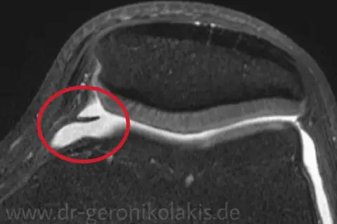 MRT-Aufnahme eines Knies mit rot markiertem Plica-Syndrom, wie es bei Liebscher & Bracht bekannt ist.
