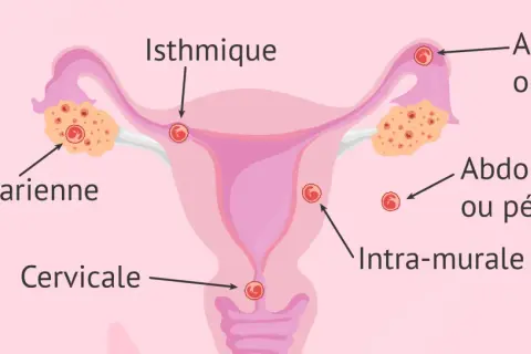 Schéma illustrant les différents sites d'une grossesse extra-utérine : ovarienne, isthmique, ampullaire, abdominale, cervicale et intra-murale.
