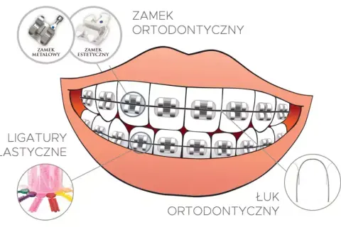 Jak założyć aparat na zęby? Etapy, koszty i pierwsze dni