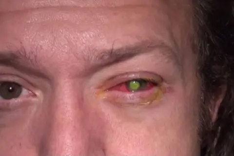 A person's right eye is red and irritated, with a green contact lens visible. This image serves as a stark warning about the dangers of asking "can I sleep with contacts?