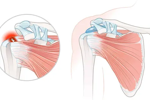 Schulteransicht mit Darstellung einer Tendinopathie der Supraspinatussehne, die entzündet und gerissen ist.