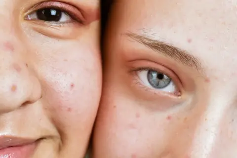 Visages de deux personnes montrant des imperfections cutanées, possiblement des maladies de peau dues au stress.