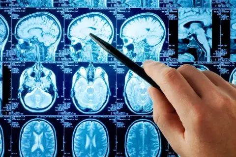 Rezonans magnetyczny a choroby psychiczne: co naprawdę wykryje MRI?