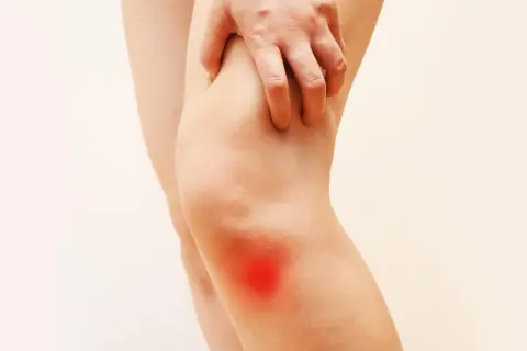 Mano che si stringe sul ginocchio con un'area rossa che indica fitte al ginocchio.