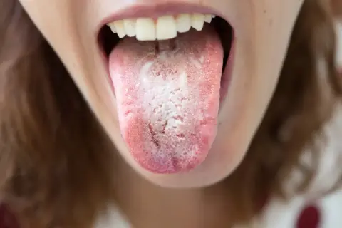 Lingua con placche biancastre e rossore, possibile candidosi orale.