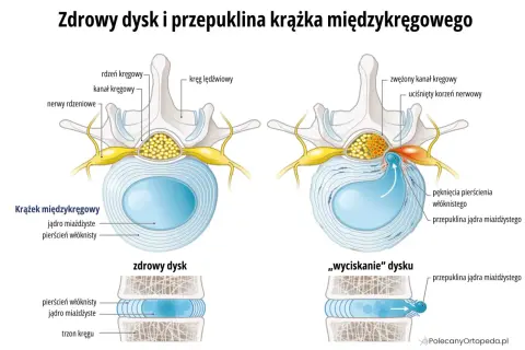 Porównanie zdrowego krążka międzykręgowego z jego przepukliną, która uciska nerwy. Widoczna protruzja krążka.