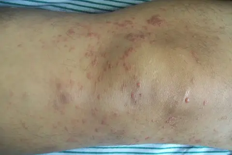 Hautveränderungen, die auf Mycosis fungoides hindeuten, zeigen sich als rote, schuppige Flecken und Plaques am Bein.