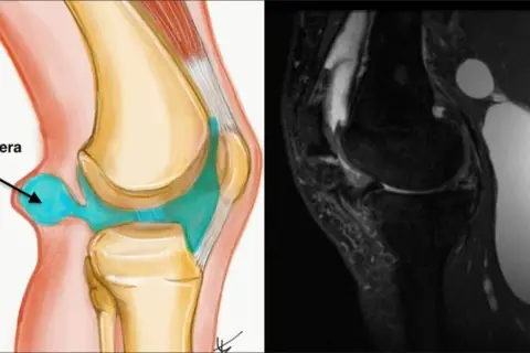 Ilustracja anatomiczna i rezonans magnetyczny ukazują torbiel Bakera w dole podkolanowym, wypełnioną płynem.