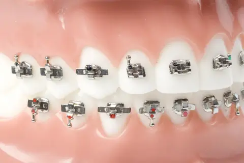 Modello di denti con apparecchio ortodontico, con attacchi metallici e fili che sembrano piccole stelline.