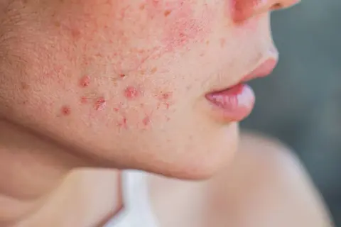 Gros plan sur une joue avec des rougeurs et des marques d'acné, suggérant des solutions pour comment enlever les cicatrices de boutons.