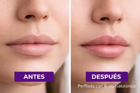 Comparativa de perfilado de labios antes y después, mostrando un aumento de volumen y definición gracias al ácido hialurónico.