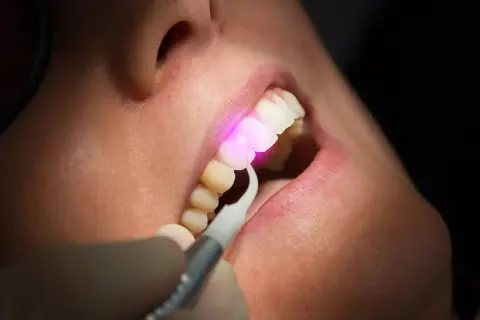 Trattamento dentale con laser. Un raggio rosa illumina un dente, mostrando la precisione della laser dentistry.