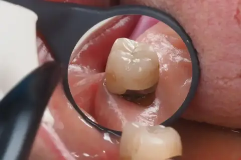 Widok z lusterka dentystycznego na ząb z widoczną koroną kompozytową, która chroni go przed dalszym uszkodzeniem.