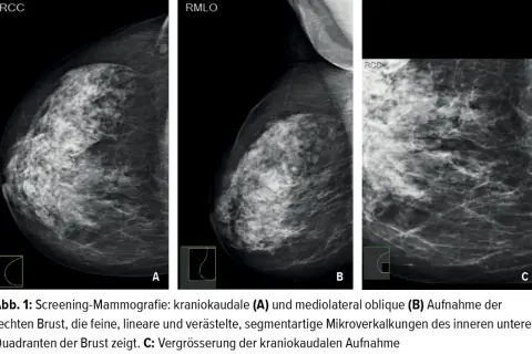 Mammografie-Aufnahmen zeigen feine, lineare Mikroverkalkungen in der Brust.