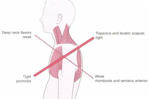 Anatomia karku i barków: napięty mięsień czworoboczny, osłabione zginacze karku, napięte mięśnie piersiowe, osłabione mięśnie równoległoboczne.
