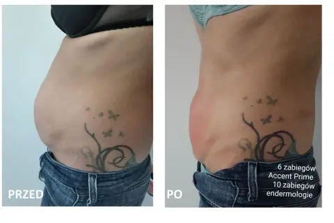 Przed i po zabiegach Accent Prime i endermologii. Widoczna redukcja tkanki tłuszczowej, efekt podobny do liposukcji kawitacyjnej.