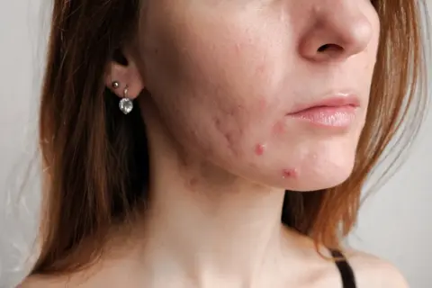 Skóra z niedoskonałościami i śladami po pryszczach. Szukasz sposobu, jak szybko zagoić ranę po pryszczu domowe sposoby?
