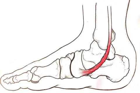 Illustrazione anatomica del piede con tendine d'Achille infiammato, evidenziando la **tendinite caviglia**.