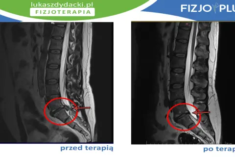 Przed i po terapii: rezonans magnetyczny kręgosłupa z widoczną dyskopatią L5/S1, która po leczeniu uległa poprawie.
