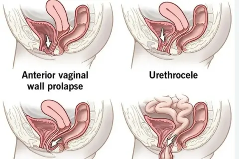 Illustrations de prolapsus vaginal. La question "peut-on avoir des rapports avec un prolapsus" est complexe et dépend de la sévérité.