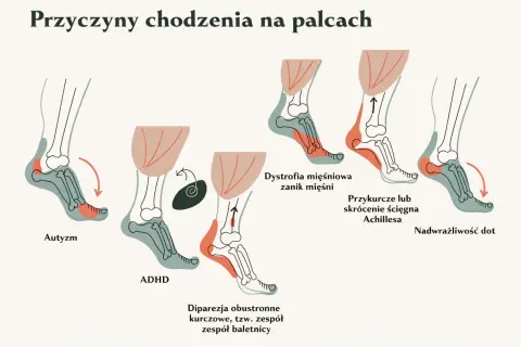 Ilustracja pokazuje, że dziecko chodzi na palcach z różnych powodów: autyzm, ADHD, dystrofia mięśniowa, przykurcz ścięgna Achillesa, dipareza kurczowa i nadwrażliwość dotykowa.
