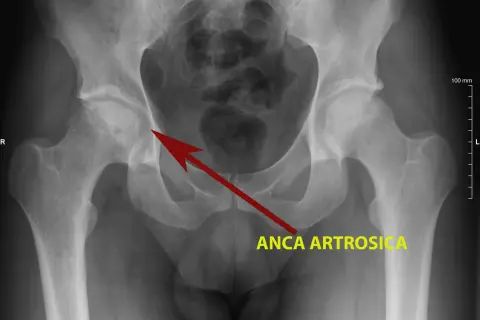 Radiografia del bacino che mostra una rima di radiotrasparenza nell'anca destra, indicata da una freccia rossa e dalla scritta "ANCA ARTROSICA".