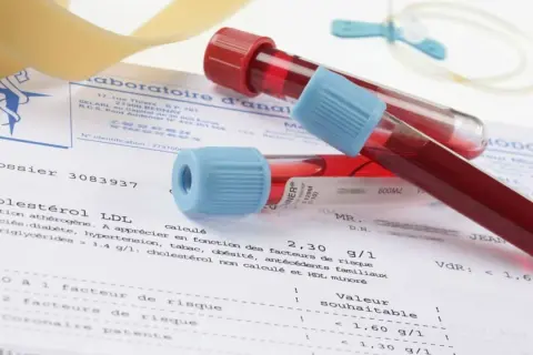 Próbki krwi w probówkach leżą na wynikach badań, gdzie widnieje m.in. "Cholestérol LDL". Badanie to pomaga ocenić ryzyko chorób serca, a jego wyniki są kluczowe, by zrozumieć, crp co to znaczy dla zdrowia.