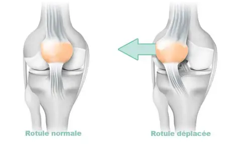 Comparaison d'une rotule normale et d'une rotule déplacée, illustrant la **dysplasie femoro patellaire**.