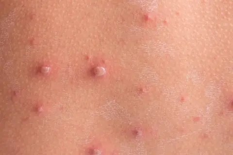 Początki ospy na skórze: drobne, czerwone krostki i pęcherzyki, niektóre z białym czubkiem.