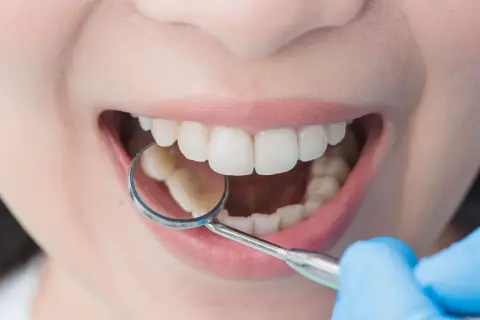 Esame dentale con specchietto. Si nota un lieve affollamento dentale, ma i denti sono ben allineati.