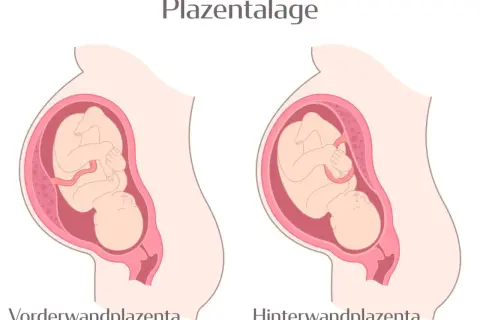 Zwei Darstellungen einer Schwangerschaft: Links eine vorderwand plazenta, rechts eine hinterwandplazenta. Der Fötus ist in beiden Fällen gut erkennbar.