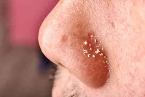 Skóra nosa z widocznymi zaskórnikami zamkniętymi. Przyczyny ich powstawania to m.in. nadmiar sebum i martwy naskórek.