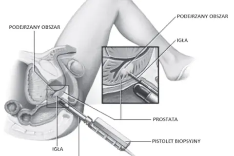 Biopsja prostaty: Co musisz wiedzieć? Przebieg, przygotowanie, wyniki