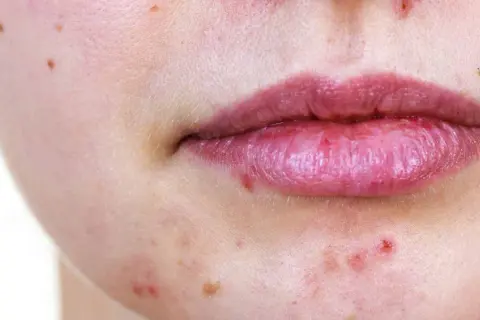Gros plan sur une bouche et un menton présentant des rougeurs et des micro kystes sur le visage.