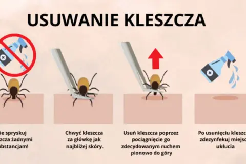 Jak bezpiecznie usunąć kleszcza? Sprawdzony poradnik krok po kroku