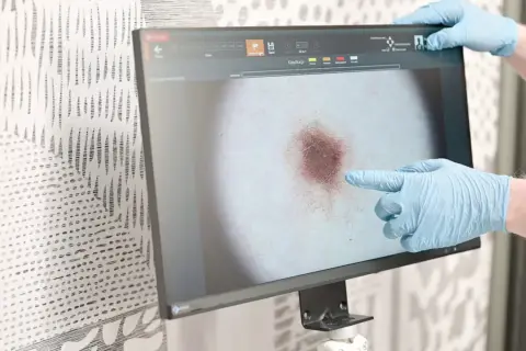 Dermatolog w rękawiczkach wykonuje badanie dermatoskopowe, analizując obraz znamienia na monitorze.