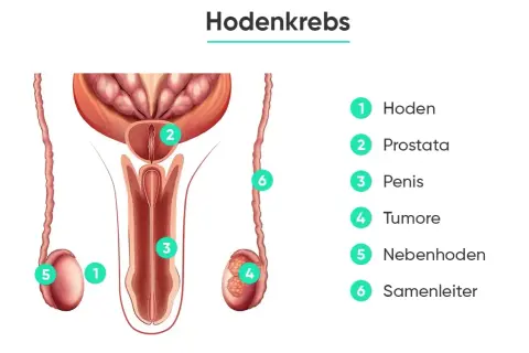 Anatomische Darstellung des männlichen Genitalbereichs mit Beschriftungen. Ein Tumor (4) ist im Hoden (1) zu sehen. Die Hodenkrebs prognose hängt vom Stadium ab.
