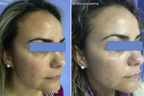 Comparación antes y después de un peeling para manchas. La piel luce más uniforme y luminosa tras el tratamiento.