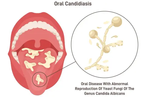Bocca con lesioni biancastre sul palato e sulla lingua, indicative di candida. Zoom su funghi microscopici.
