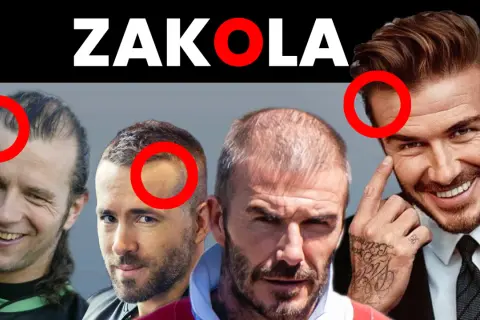ZAKOLA. Czterech mężczyzn z widocznym łysieniem androgenowym, zaznaczone czerwonymi okręgami. Fryzura w kontekście utraty włosów.